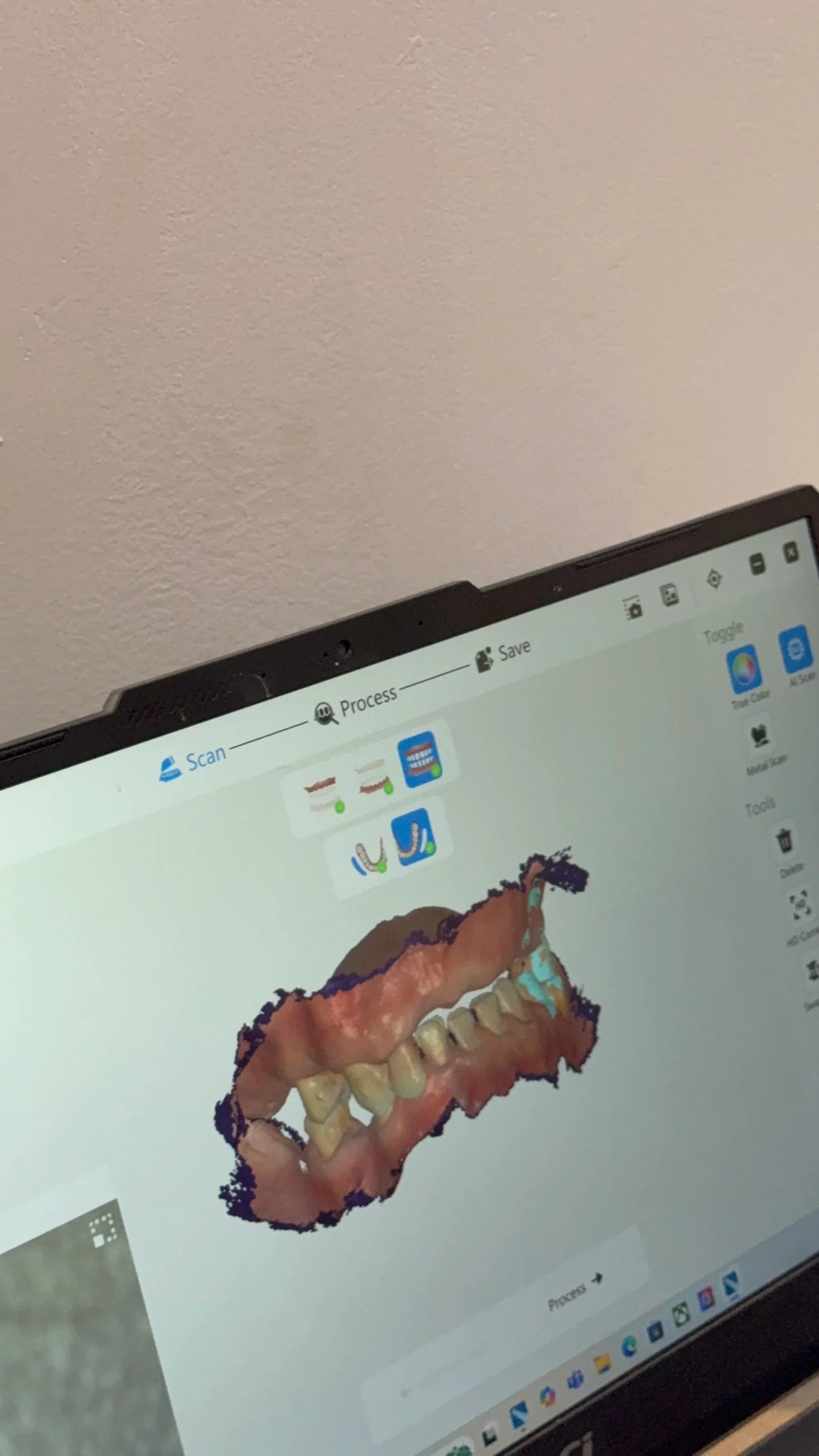 3D Intraoral Scanner thumbnail 9