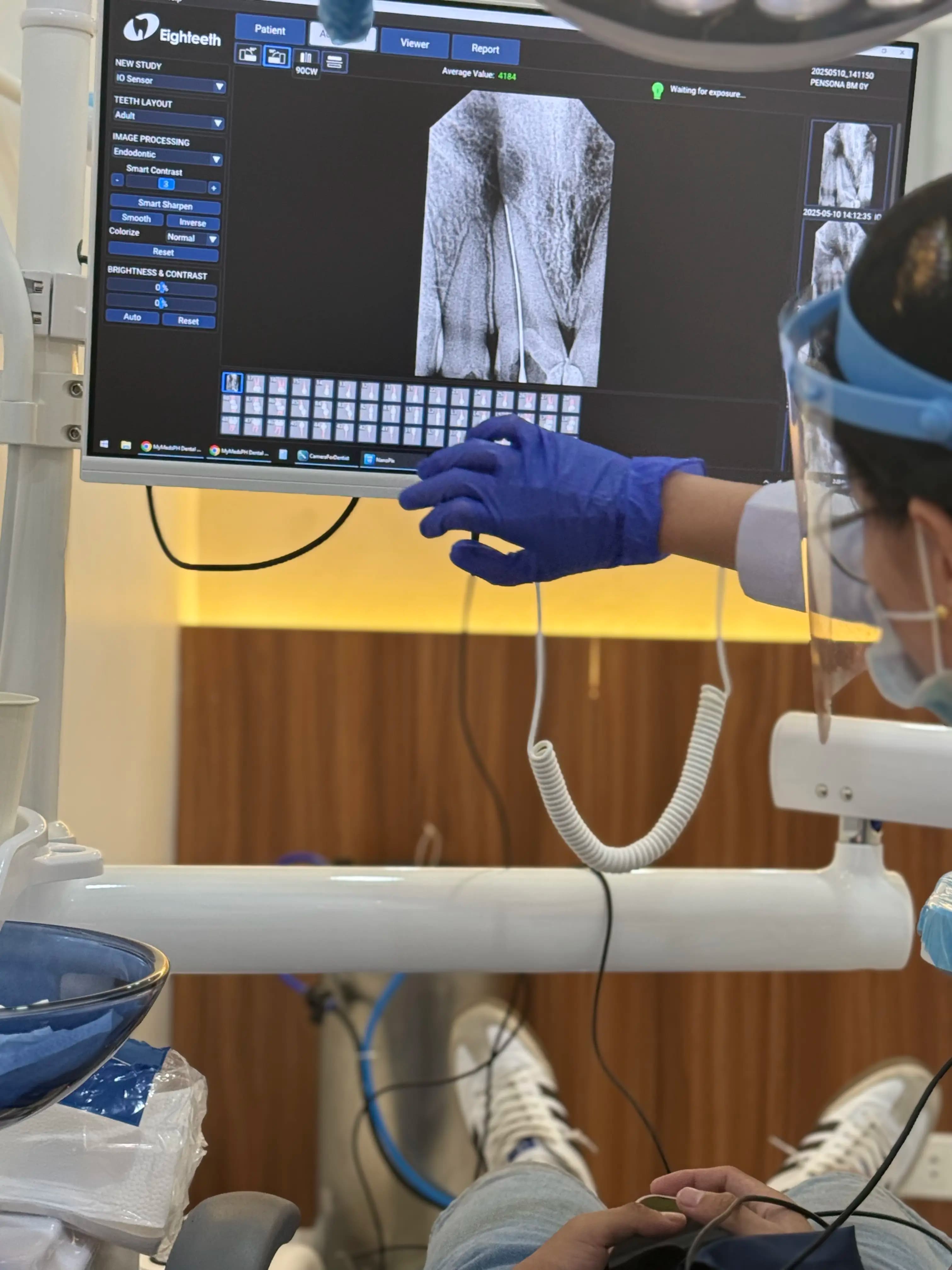 Periapical X-Ray thumbnail 4