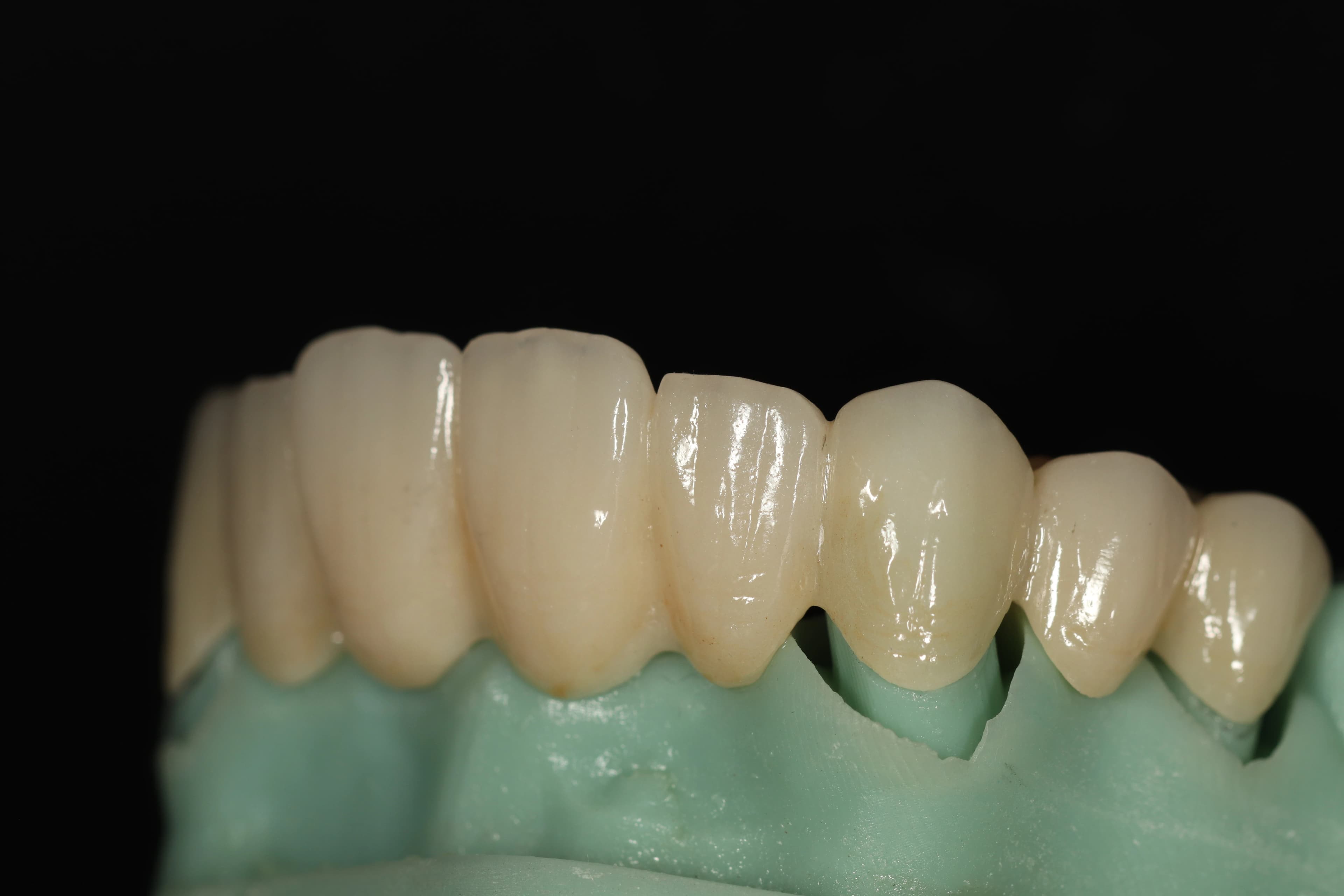 Full mouth reconstruction result