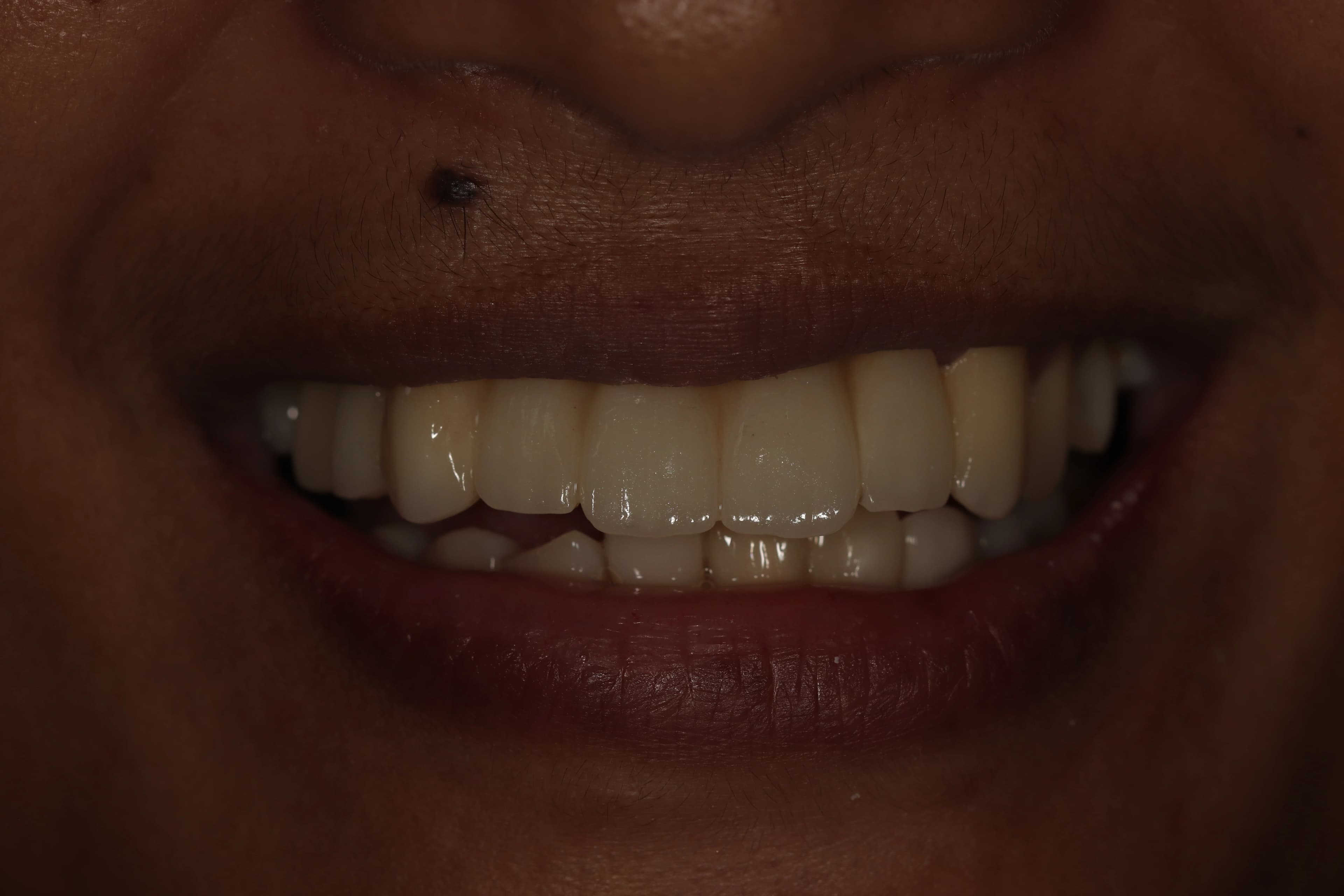 Full mouth reconstruction result